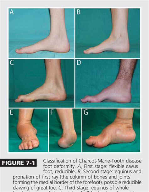 charcot marie tooth disease icd10  These genes are not located on the chromosomes associated with determining biological sex