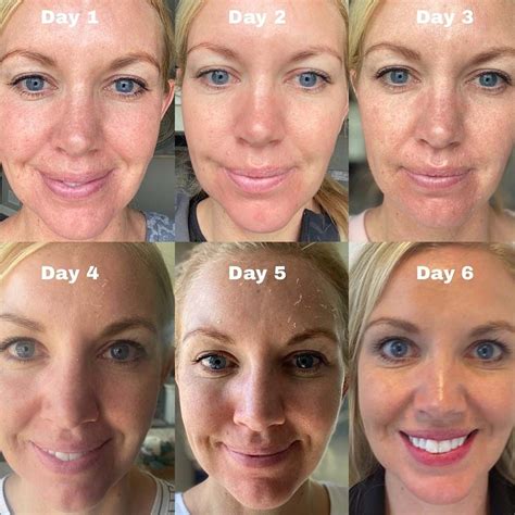 chemical peel sammamish  Reduce wrinkles