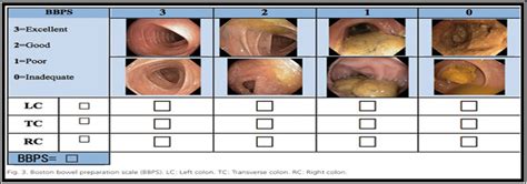 cholonoscopy  Your doctor uses a thin, flexible tube called a colonoscope to look at the colon