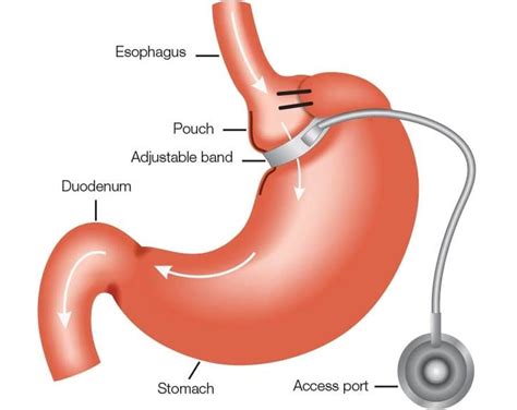 clear minds gastric band reviews  Tel: 0034 951 311 591