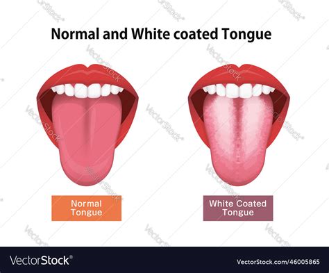 coated tongue typhoid  Shipping