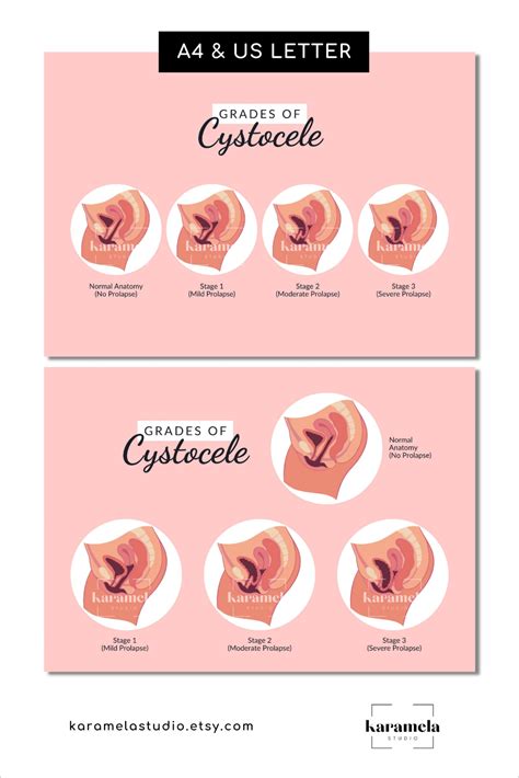 cystocele adalah  en