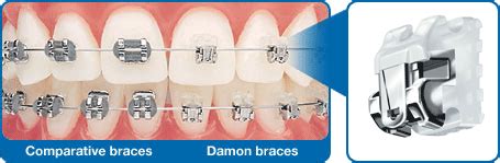 damon bracket placement guide  To-Serve-Man by Damon Knight