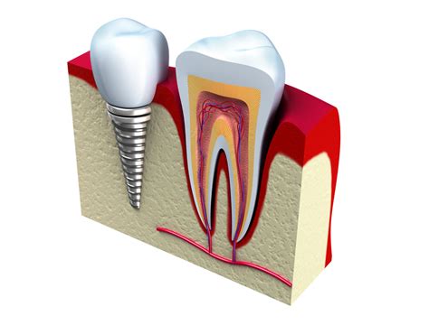 dental implants faqs pomona ny  Missing teeth can affect your ability to enjoy foods you once loved