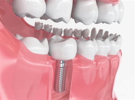 dental implants hodgenville  The best option, especially if the missing tooth space has no surrounding teeth, is a dental implant