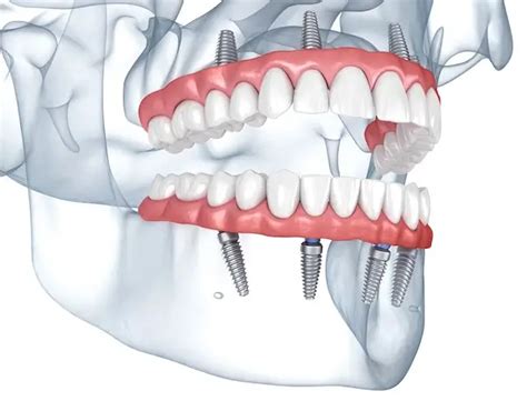 dental implants huntington ny  959 Brush Hollow Road, Suite 102 Westbury, NY 11590 61 E