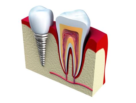 dental implants vs dentures glyndon md 4664Dr