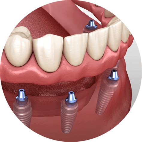 dental implants yuba city  Access business information, offers, and more - THE REAL YELLOW PAGES®New Patients: 530-418-5145 Current Patients: 530-671-4784 Address: 1052 Live Oak Blvd