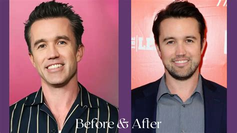 did rob mcelhenney have plastic surgery Rob McElhenney Plastic Surgery