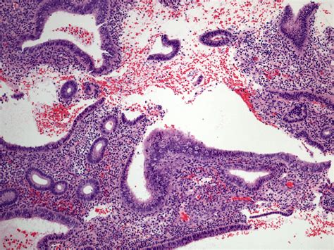 disordered proliferative phase endometrium 5%) revealed secretory phase