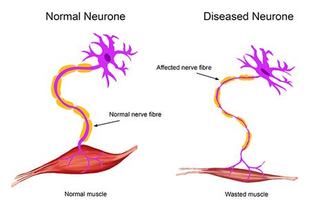 does nicholas cassim have motor neurone disease MND attacks cells in the nerves called motor neurones