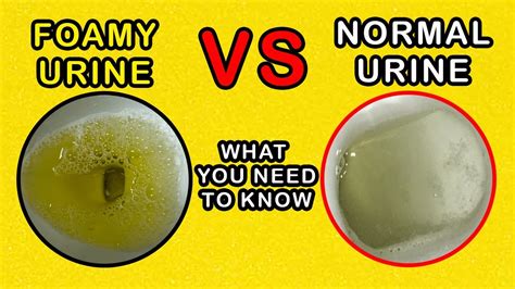 does uric acid cause foamy urine  At this point, a person expels it from the body