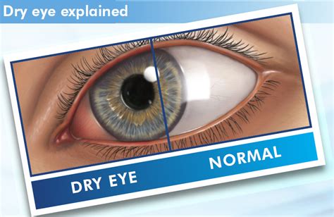dry eye west springs  5 Healthgrades 5-Star Rating s