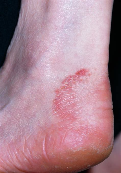 dyshidrotic eczema caused by fungal infection  2