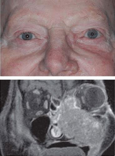 e11.3393  Without macular edema and other specified diabetes