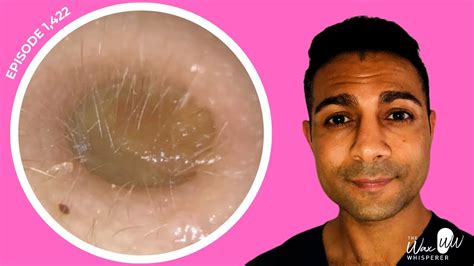 ear wax removal maldon &nbsp;Same day appointments available