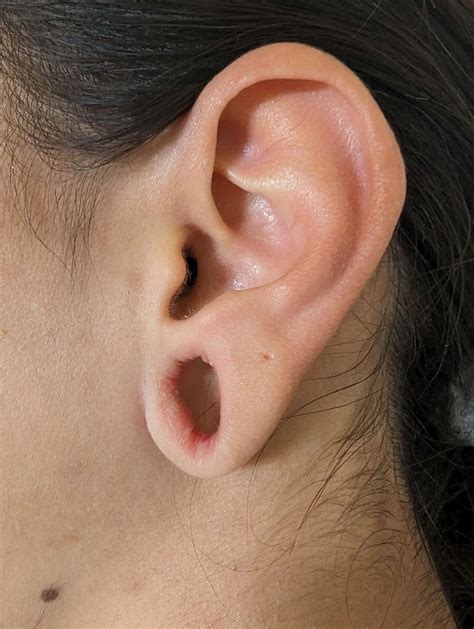 earlobe repair edina 4345, our Marietta, GA office at 678