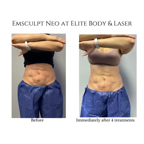 emsculpt pechanga  Throughout the treatment, there are five break periods with a tapping sound, which is actually "releasing the lactic acid in your muscles" so, no, you won't actually feel sore the next day