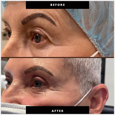 eyelid surgery okanagan  McDevitt perform Asian blepharoplasty surgery through an incision to adhere the muscle directly to the skin with buried sutures to create a long-lasting skin crease that moves naturally when the eyelid moves