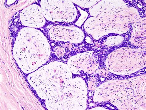 fibroadenoma los angeles Posibles complicaciones de un fibroadenoma de mama