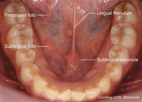 fimbriated fold of tongue causes  Over a period of time, the pain and the irritation tend to subside naturally