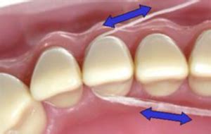 flossing c shape Curve the floss into a C-shape as you slide it up and down along the side of each tooth