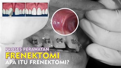 frenektomi adalah Apakah Anda ingin mengetahui bagaimana melakukan frenektomi dan depigmentasi gingiva di regio anterior atas sebelum perawatan ortodontik? Baca artikel ini untuk