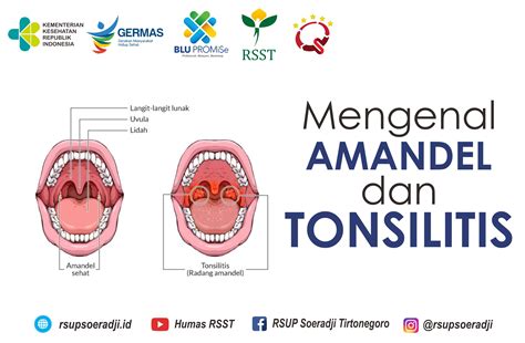 fungsi tonsil adalah  Report