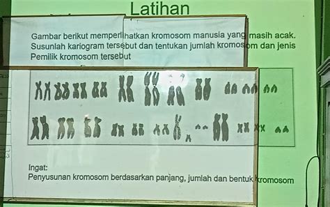 gambar kromosom manusia  Manusia yang mengalami kerusakan kromosom trisomik kromosom gonosom akan mengalami… Sindrom Down