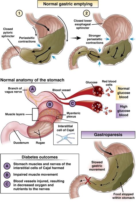 gastroparesis dm icd 10  Common symptoms of gastroparesis include nausea (>90% of patients), vomiting (84% of patients), and early satiety (60% of patients) (1,2,3)