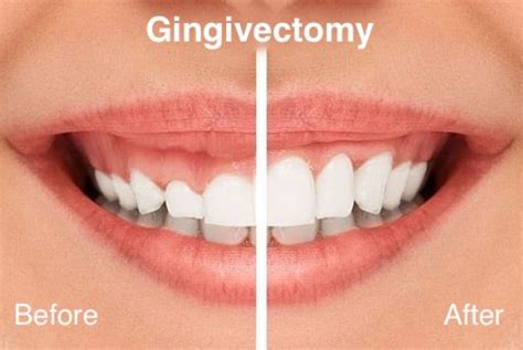 gingivectomy greenwich ct  See prices & compare results