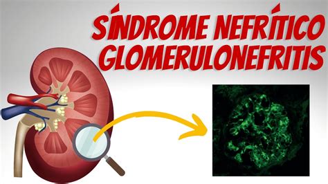 glumerulonefritis  Glomerulonefritis