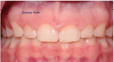 gummy smile stamford A gummy smile refers to a smile where there’s an excessive display of the upper gum, aka gingival tissue (1)