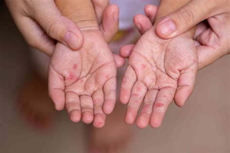 hand foot mouth disease icd 10  What is Hand, Foot, and Mouth Disease? Hand, foot, and mouth disease is is caused by viruses that belong to the Enterovirus family