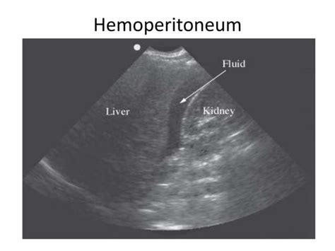 hemoperitoneum adalah  It is written by experts from the Faculty of Medicine, Universitas Airlangga, and covers topics such as trauma, poisoning, infection, shock, and organ failure