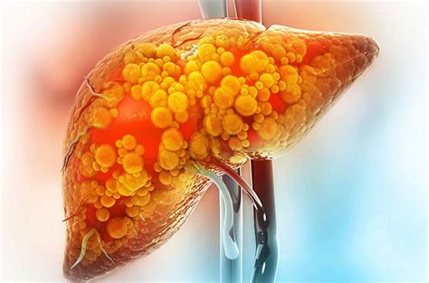 hepatosplenomegali adalah  Diphteria Penularan : Droplet melalui saluran napas