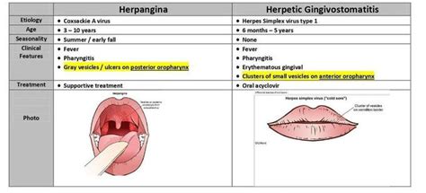 herpangina vs gingivostomatitis  The 2024 edition of ICD-10-CM B00