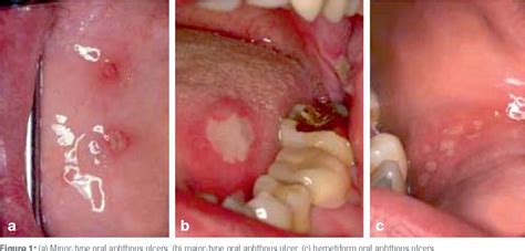 herpangina vs gingivostomatitis The typical oral and extraoral lesions make the diagnosis straight forward and accurate in approximately 80% of children who are clinically suspected of infection
