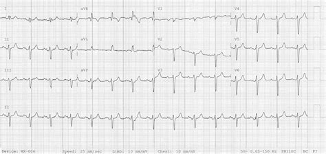 hipertrofia biatrial é perigoso Sim / Não