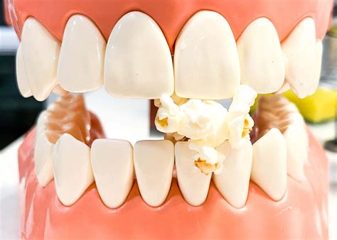 how to get a popcorn kernel out of your gums  1