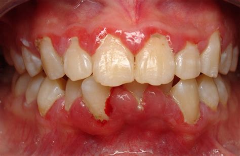 imflamed gums Swollen gums are caused by multiple factors that result in inflammation of the gums