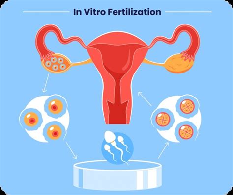 in vitro fertilization ivf near rohnert park  In vitro fertilization (IVF) combines a woman’s eggs and a man’s sperm in a laboratory to produce an embryo