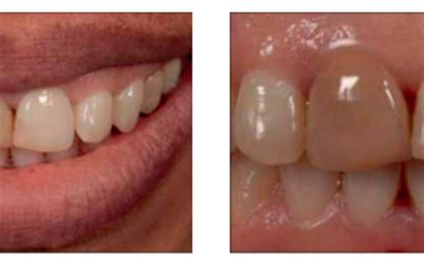 infecção dente desvitalizado  Usar sucção e gaze para remover o pus exsudativo