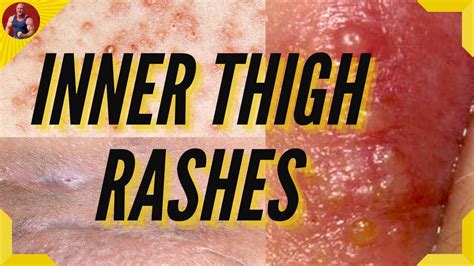 inner thigh chafing bumps  Do not rub their skin way too hard