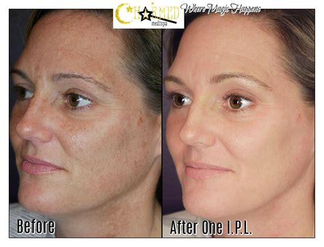 ipl treatment issaquah  Specialized in Brazilian wax, brow design, luxury organic facials, and dermaplaning