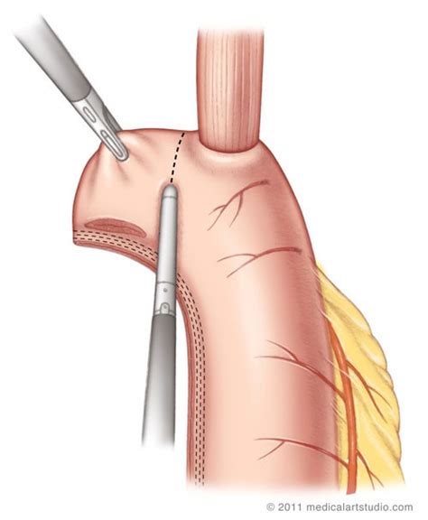 ivor lewis esophagectomy icd 10 However, creating an intrathoracic esophagogastric anastomosis under conventional thoracoscopy is