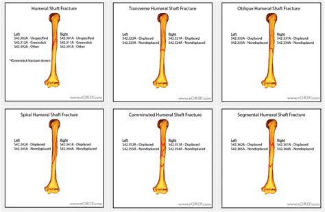 kode icd 10 fraktur patella 001A Unspecified fracture of right patella, initial encounter for closed fracture The 2023 edition of ICD-10-CM S02