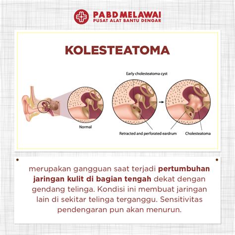 kolesteatoma Latar Belakang: Atresia canalis acousticus externus (CAE) kongenital adalah entitas langka dalam praktik klinis