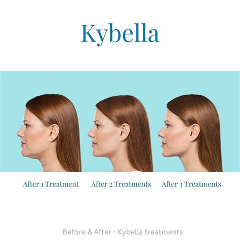 kybella omaha  Updates