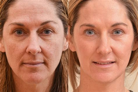 laser resurfacing sammamish  View our laser facial